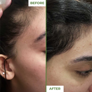 Derma Roller 0.5mm