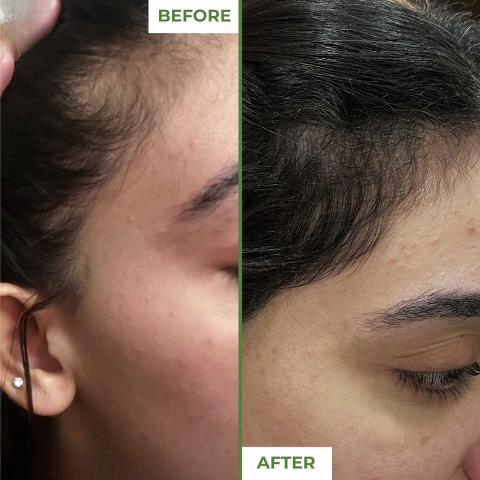 Derma Roller 0.5mm