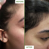 Derma Roller 0.5mm