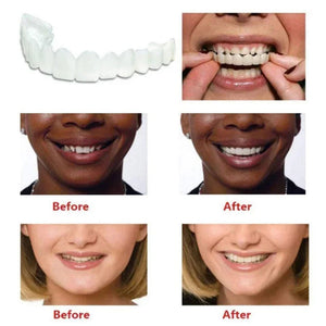Snap On Smile Braces (Premium Quality)