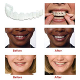 Snap On Smile Braces (Premium Quality)