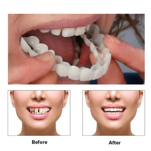 Snap On Smile Braces (Premium Quality)