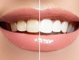 HiSmile V34™ – No More Yellow Stains, Just Bright Smiles